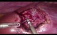 Diamond Technique of Non-anatomical Laparoscopic Liver Resection
