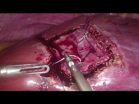Diamond Technique of Non-anatomical Laparoscopic Liver Resection