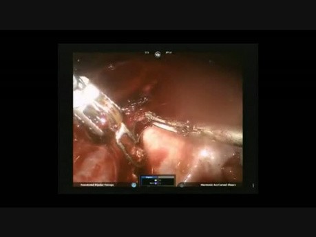 Robotic Hysterectomy with Cholecystectomy