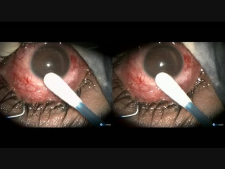 Post VR Surgery Glaucoma Management, 3D and 2D
