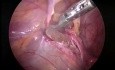 Pedriatric laparoscopic hernia repair.