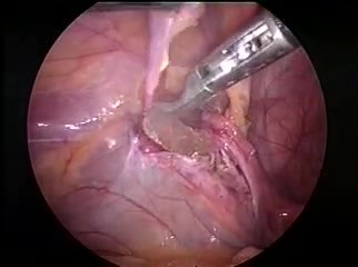 Pedriatric laparoscopic hernia repair.