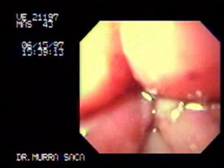 Tear of Gastroesophageal Junction Mucosa - 42  Years-Old Male