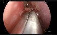 Resection of a Right Antrochonal Cyst