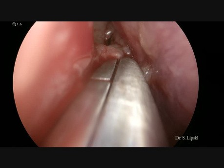 Resection of a Right Antrochonal Cyst