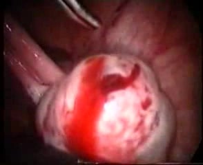 Intraperitoneal Haemorrhage From A Ruptured Corpus Luteum