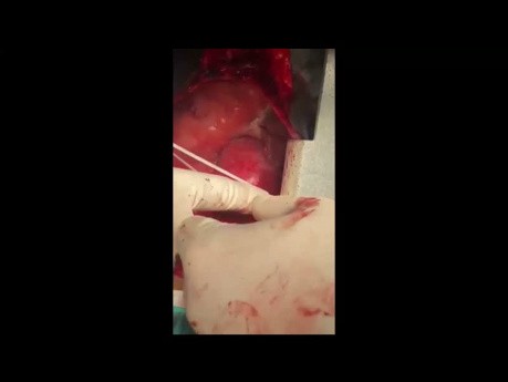 Florida Technique for Ascending Aorta Aneurysm and its Modification 