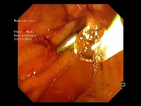 Ampullectomy Part 4 - Two Months Later