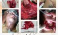 Squamous cell carcinoma of the tongue