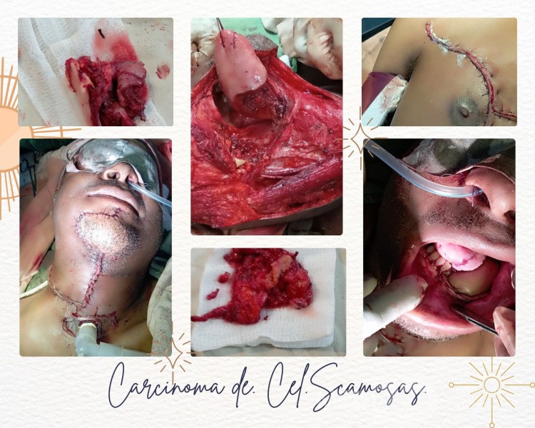 Squamous cell carcinoma of the tongue
