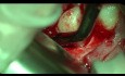 Third Molar Tooth Extraction with Laser