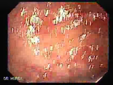 Familial Adenomatous Polyposis (7 of 36)