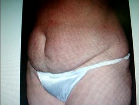 Abdominoplasty - plastic surgery