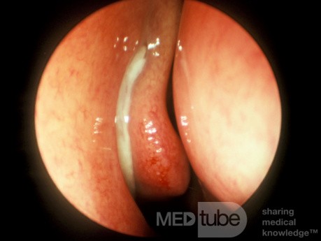 Recurrent Maxillary and Frontal Sinus Infections [right]