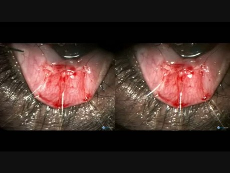 Singh's Muller Plication for Slight Ptosis. Fasanella is Out of Date