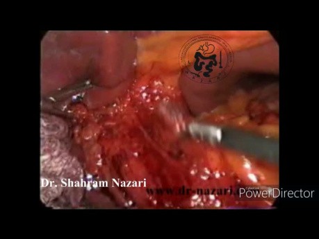 Gallbladder Agenesis Associated to Cystic Duct Absence