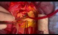 ‏Patient with Extensive Ascending Aorta Dissection Abd Valve Preserving Supra Coronary Preservation and Dean Innominate Artery Cannula