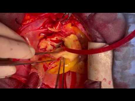 ‏Patient with Extensive Ascending Aorta Dissection Abd Valve Preserving Supra Coronary Preservation and Dean Innominate Artery Cannula