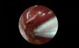 Transcanal Endoscopic Tympanoplasty for Active Chronic Suppurative Otitis Media