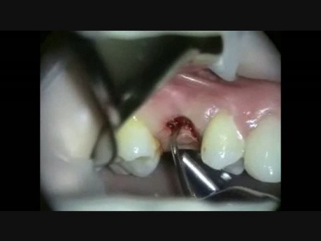 Implant Microsurgery: Deciduous Molar Transition to an Implant