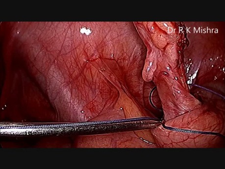Laparoscopic Appendectomy