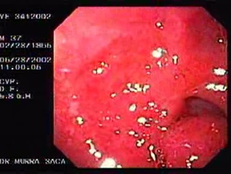 Duodenal Ulcer