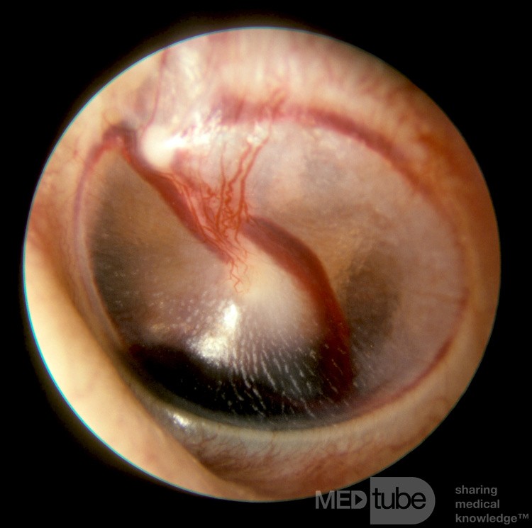 Hemotympanum From Epistaxis Case