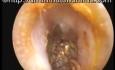 Bilateral Earwax Cumulation