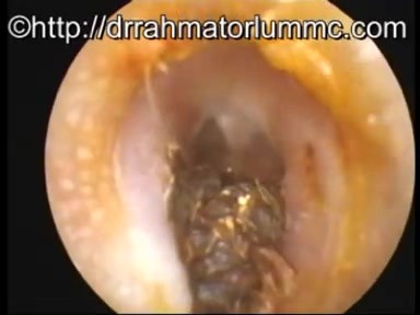 Bilateral Earwax Cumulation