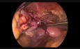 En Bloc Laparoscopic Sigmoidectomy, Left Annexectomy, Partial Small Bowel Plus Partial Urinary Bladder Resection For Advanced Sigmoid Tumor