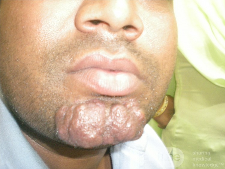 Multiple Sebaceous Cyst