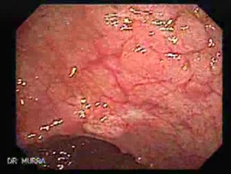 Familial Adenomatous Polyposis (18 of 36)