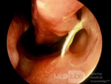 Nasal Foreign Body