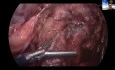Gastrojejunostomy: Principles, Techniques, and Pitfalls