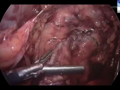 Gastrojejunostomy: Principles, Techniques, and Pitfalls