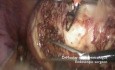Tips and Tricks - Laparoscopy in Case of Big Uterine Myoma
