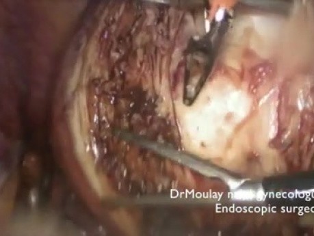 Tips and Tricks - Laparoscopy in Case of Big Uterine Myoma