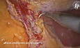 Triple Arterial Blood Supply to the Gallbladder from Aberrant Right Hepatic Artery