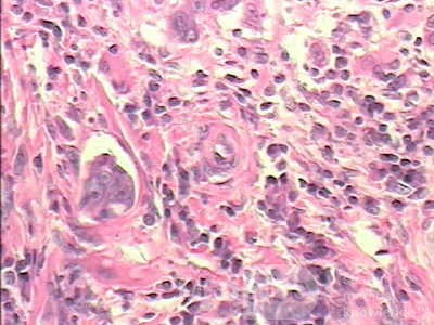 Early Gastric Cancer (19 of 21)