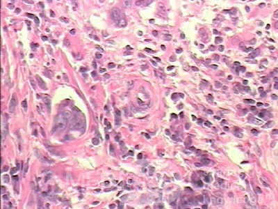 Early Gastric Cancer (19 of 21)