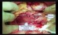 Aorta Perforation During Laparoscopy