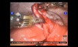 da Vinci Robotic Ovarian Cystectomy by Dr R K Mishra