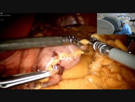 Robotic Sleeve Gastrectomy Surgery