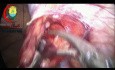 Artery preserving Laparoscopic Varicocelectomy