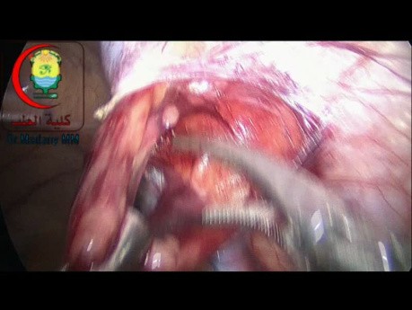 Artery preserving Laparoscopic Varicocelectomy