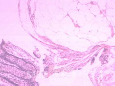 Distal Esophageal Squamous Cell Carcinoma (26of 28)
