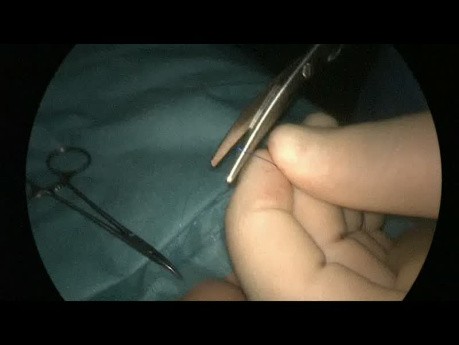 Laparoscopic Percutaneous Inguinal Hernia Repair