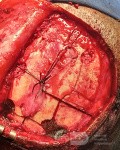 Surgical Planning with Neuronavigator in Patient with Intracranial Mass Lesion. High Grade Glioma.