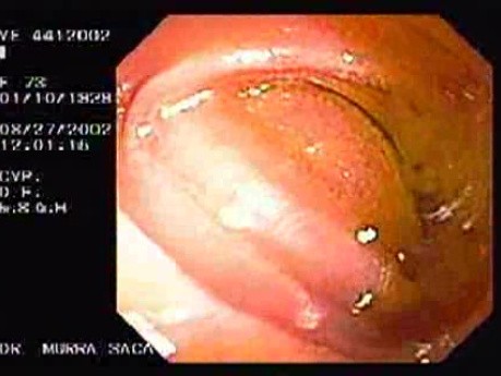 Gastric Adenocarcinoma With Signet Ring Cells - Endoscopy (3 of 4)
