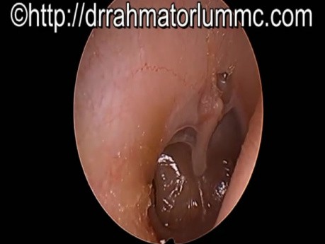 Atrophic & Atelectatic Eardrum